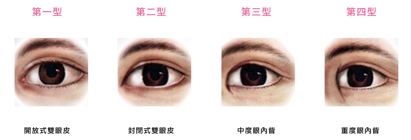 開放式雙眼皮,封閉式雙眼皮,格嘉雙眼皮